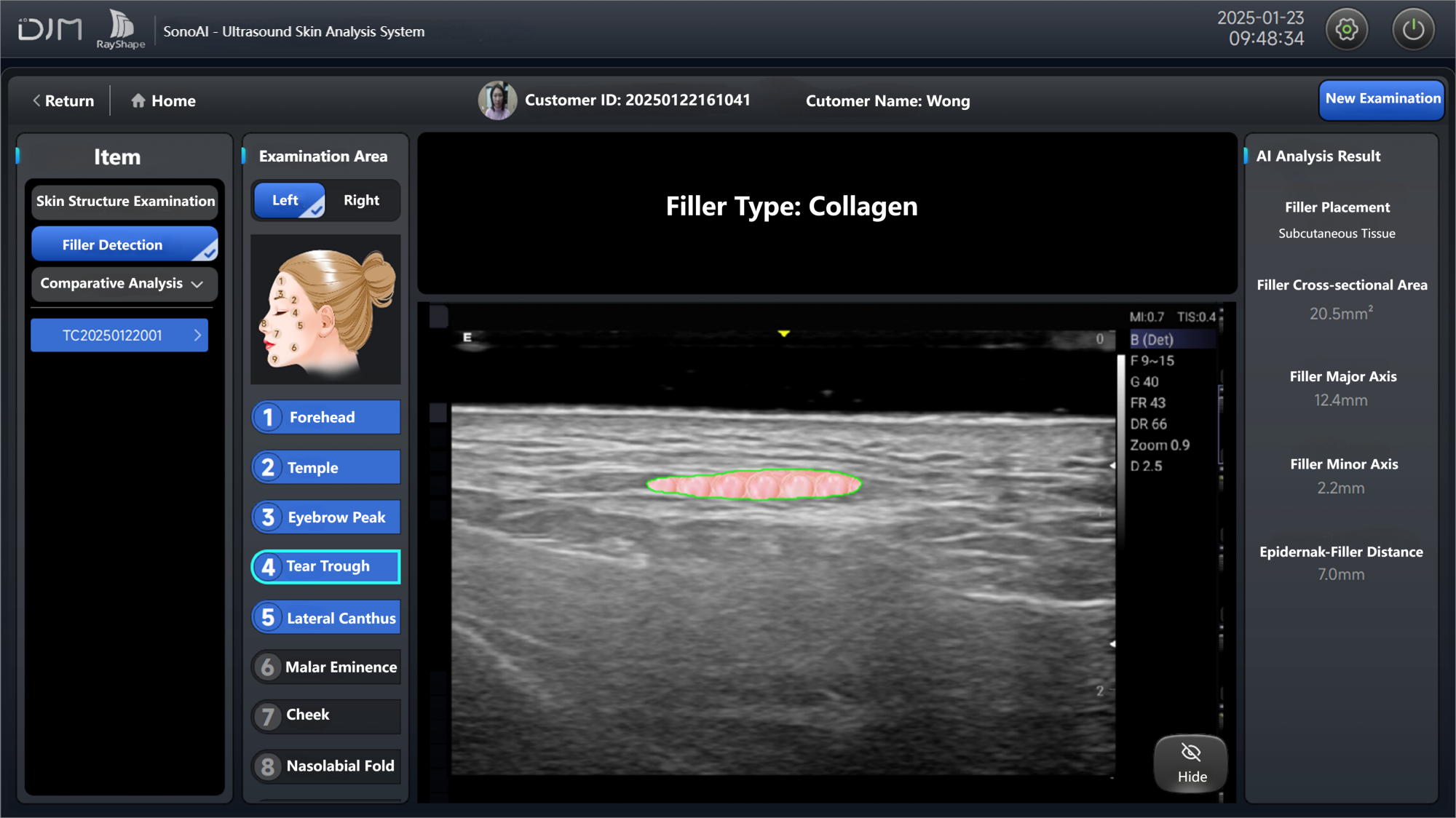 图5 填充物-胶原蛋白-EN